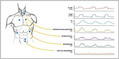 Accessory and Expiratory Muscles Activation During Spontaneous Breathing Trial: A Physiological Study by Surface Electromyography